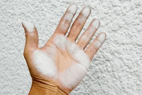 チョーキング: 表面の劣化塗料を除去後、専用塗料で再塗装